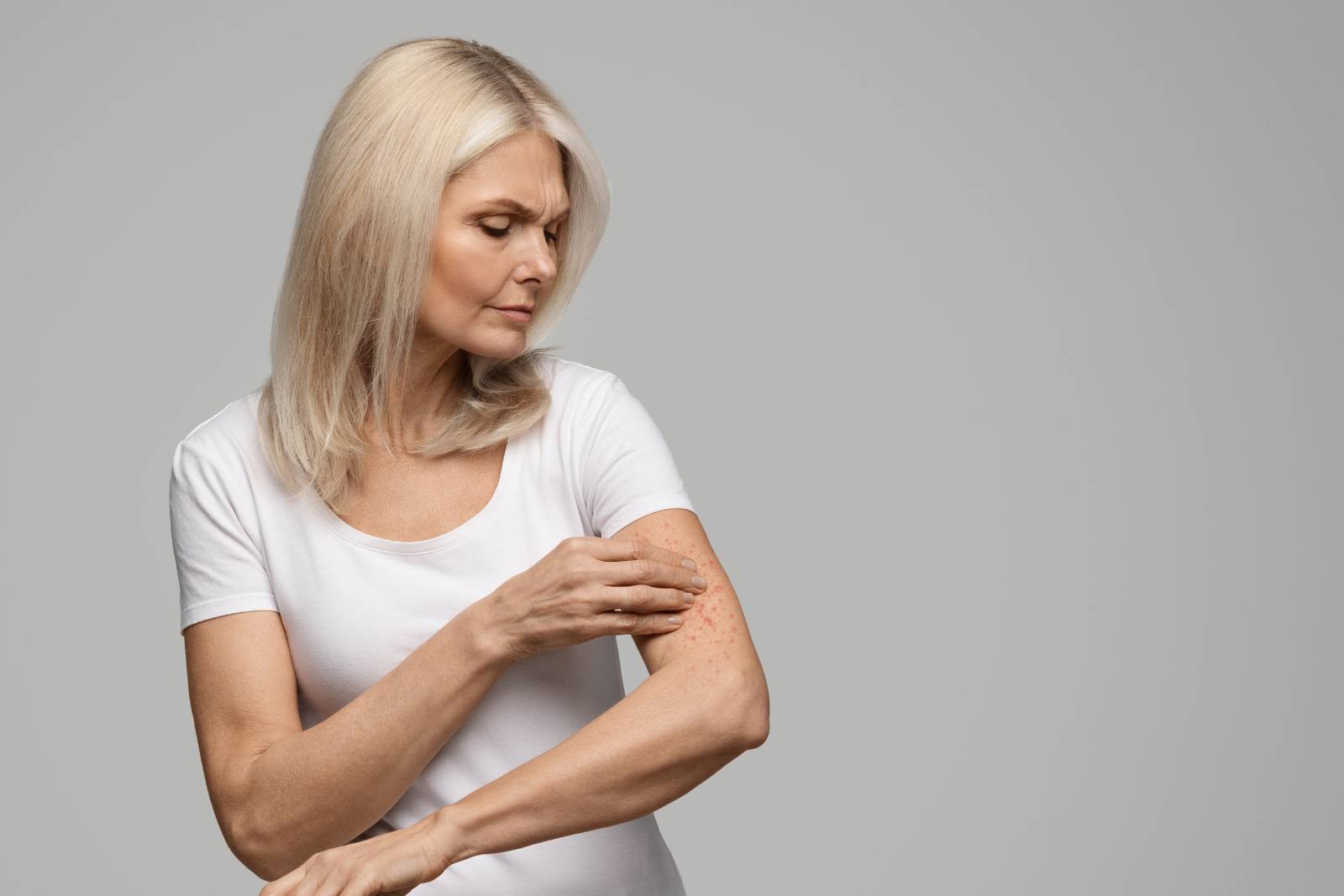 cbd dermatitis
