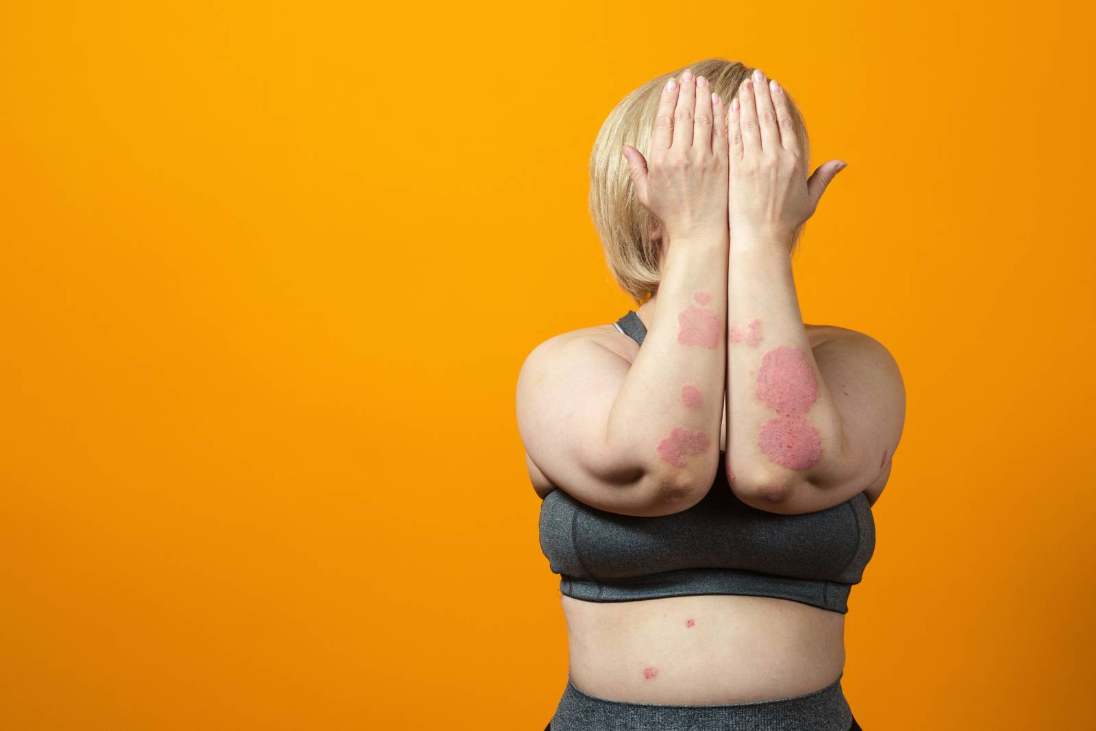 cbd psoriasis