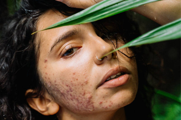 cbd and acne skin